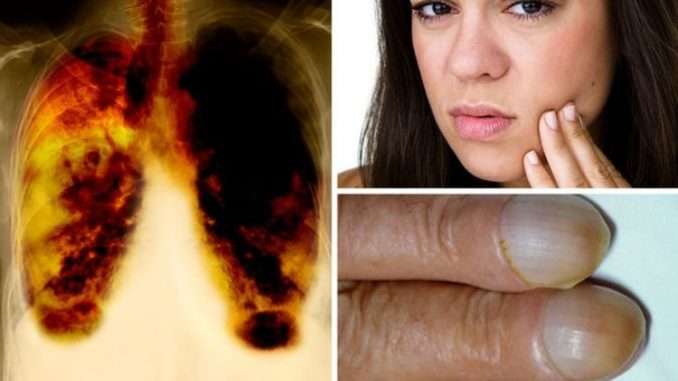 Lung cancer: Three âunusualâ symptoms to watch out for ...