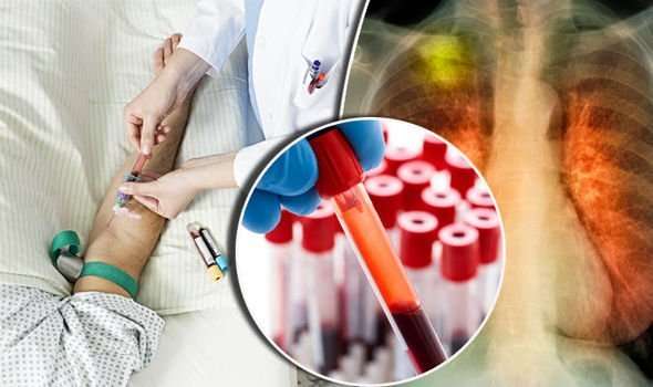 Lung cancer TREATMENT: Blood test can spot signs of ...