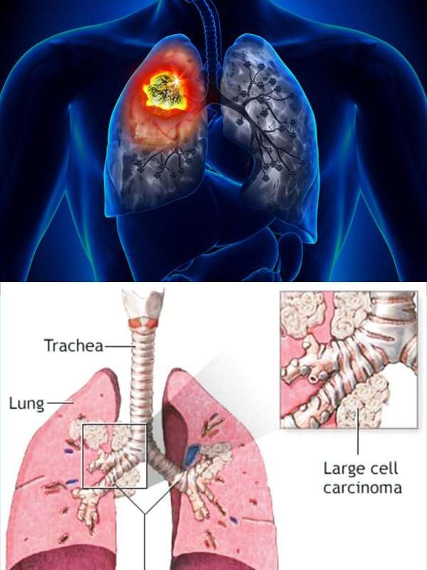 Lung Cancer Types: Treatments For Lung Cancer