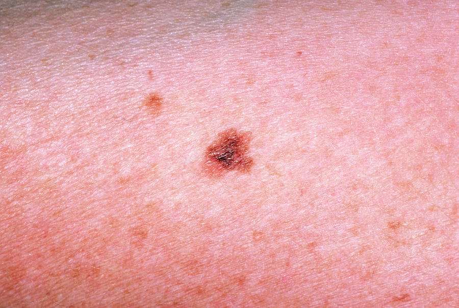 Malignant Melanoma Blemish On The Skin Photograph by Dr P ...