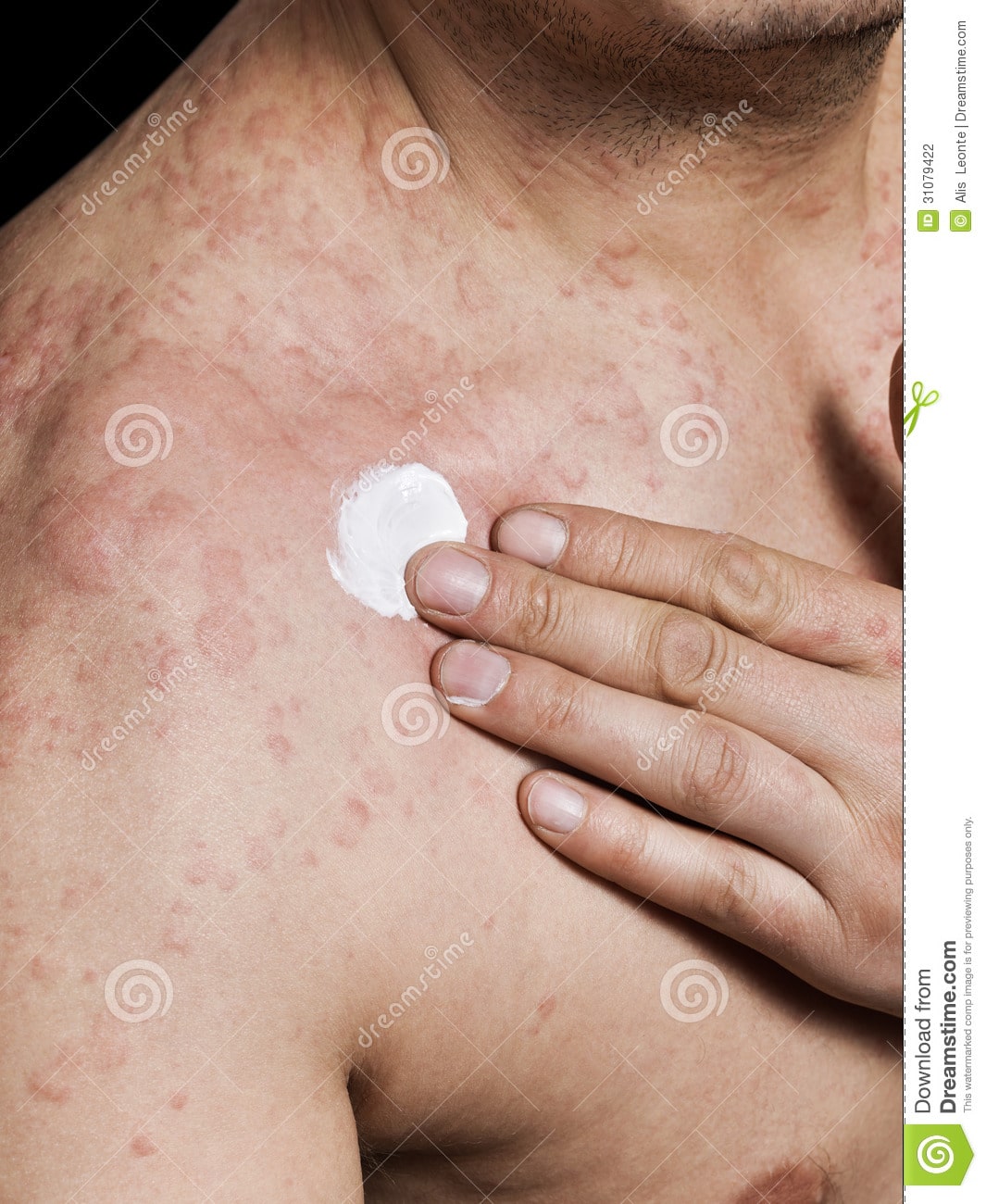 Man Applying Cream On Irritated Skin Stock Photo