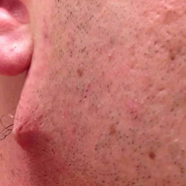 Man Pulls Longest, Most Revolting Ingrown Hair Out of His Face