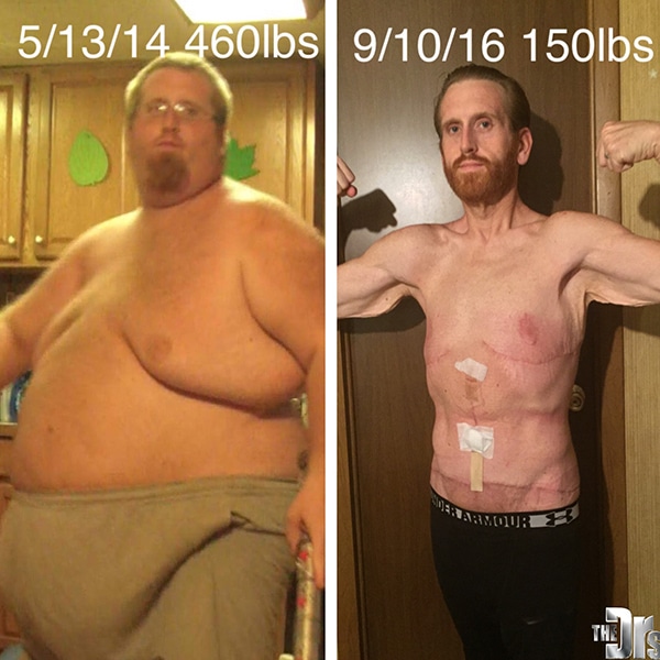 Man Who Lost 315 Lbs. Undergoes Massive Skin Removal Surgery Requiring ...