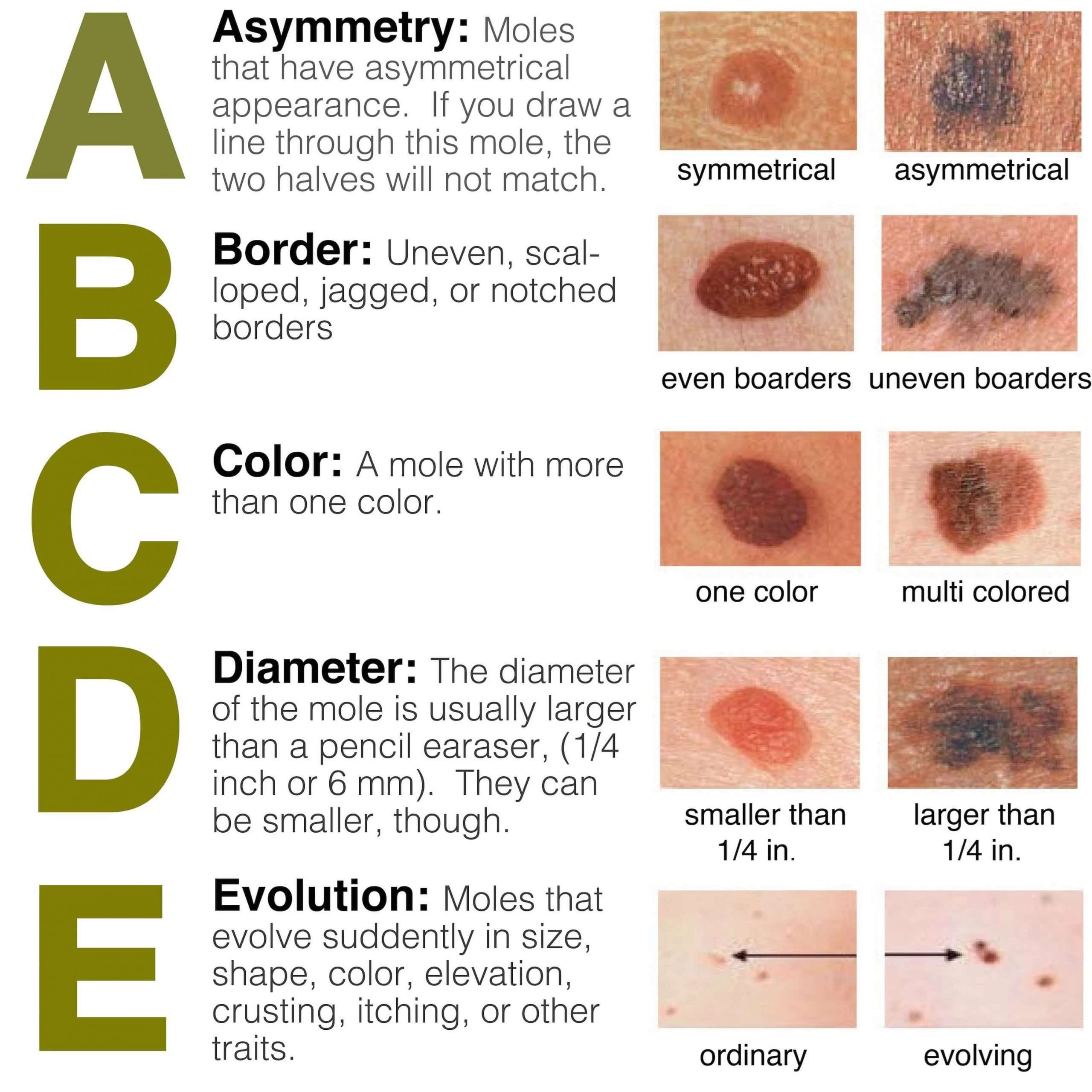 May is Skin Cancer Awareness Month: Skin Cancer is an ...