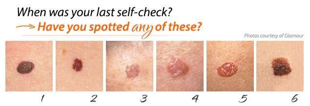 May is Skin Cancer Awareness  Rejuvent Medical Spa Scottsdale
