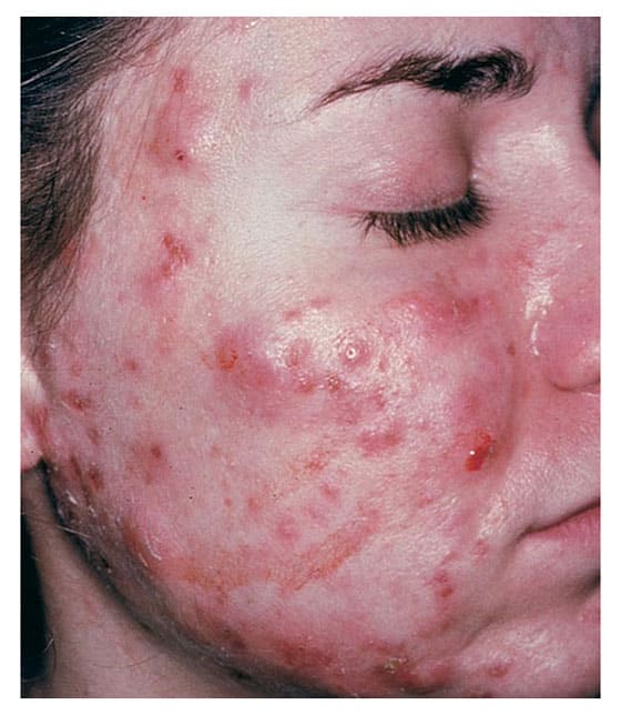 Medical Pictures Info â Cystic Acne