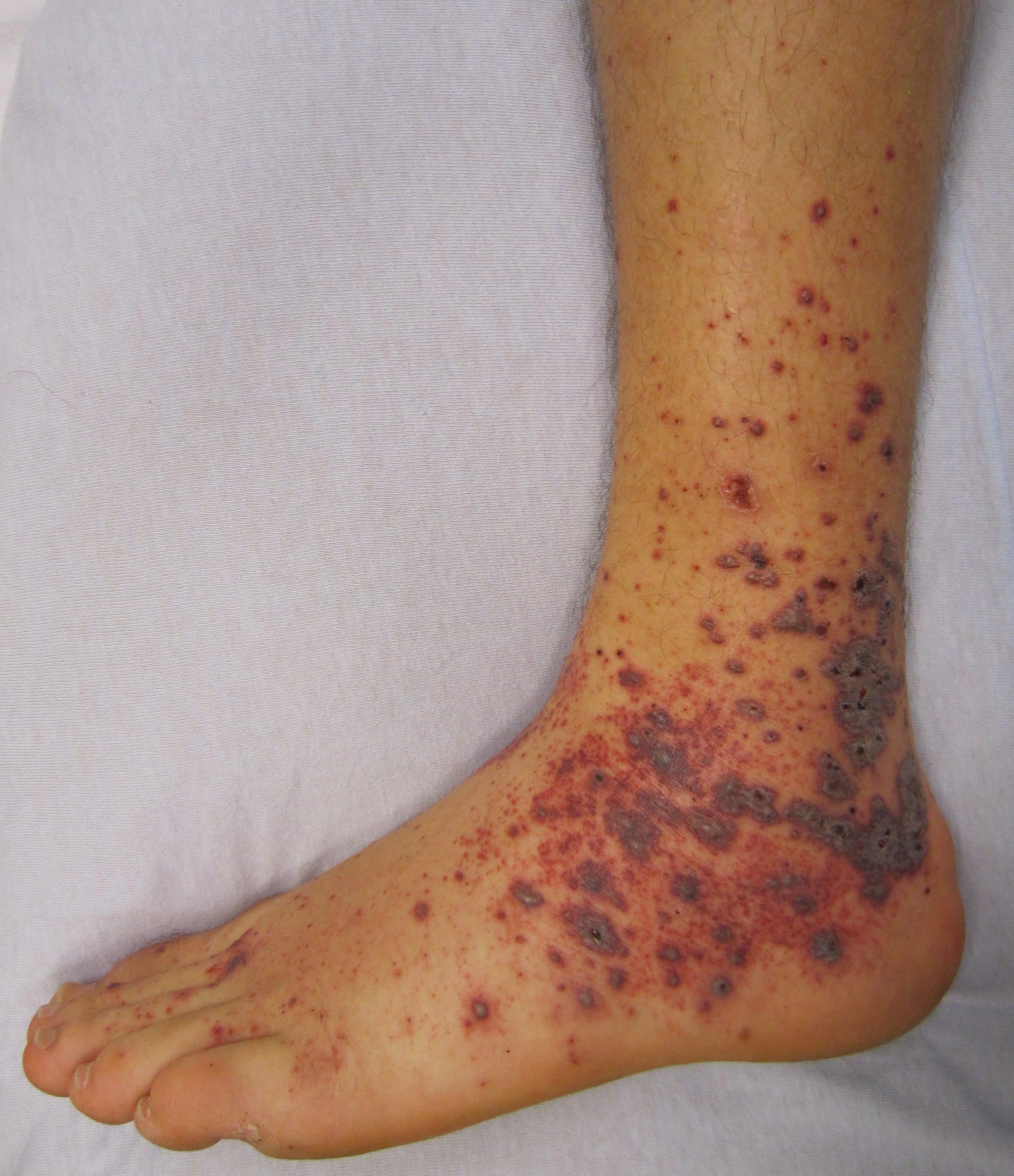 Medical Pictures Info  Allergic Purpura