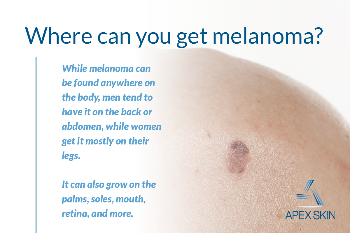 Melanoma: A Skin Cancer Expert Shares What You Need to ...
