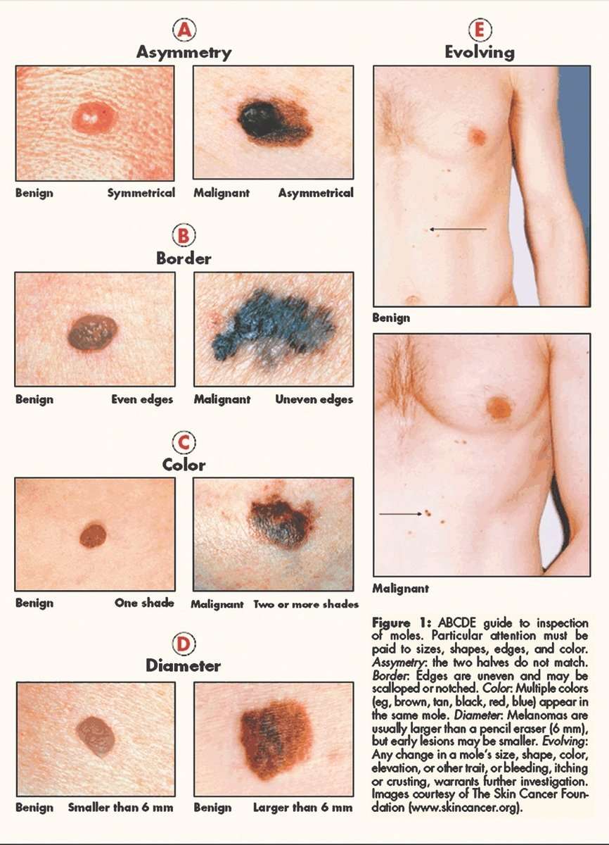 Melanoma  early detection and treatment are critical ...