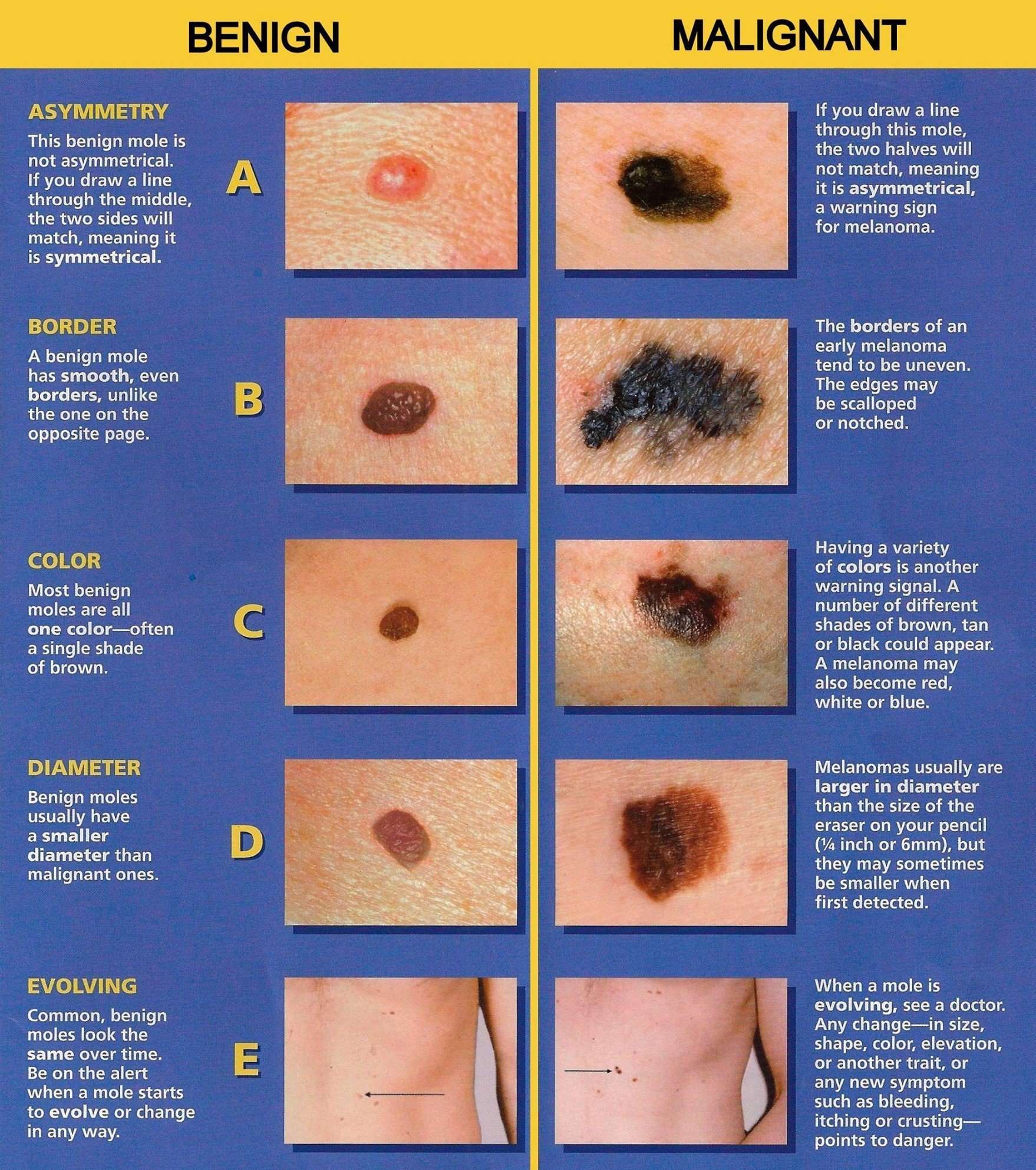 Melanoma: How do you know if a mole is dangerous?