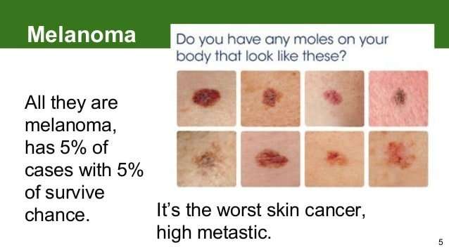 Melanoma: how to detect skin cancer