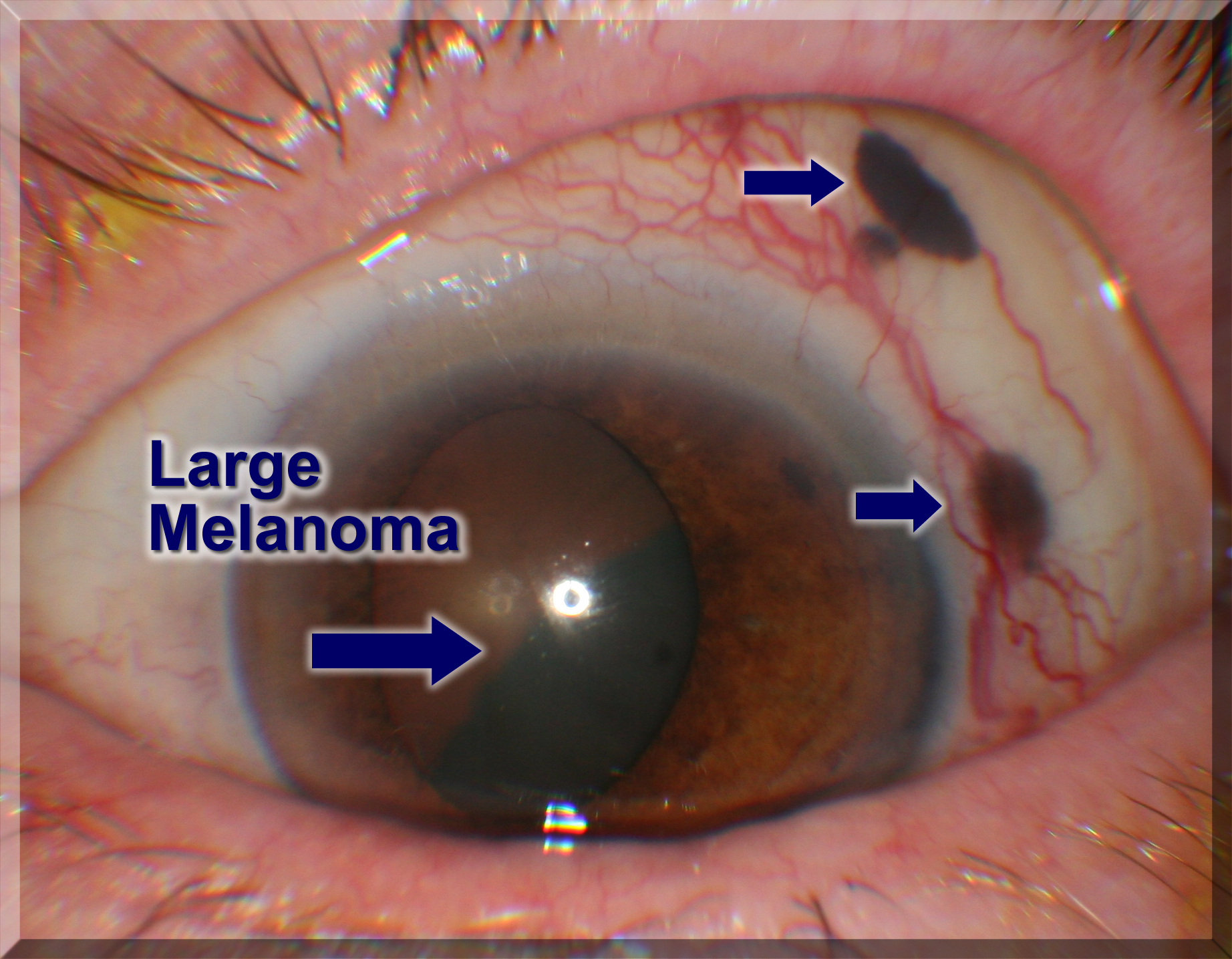 Melanoma of the eye. Causes, symptoms, treatment Melanoma ...