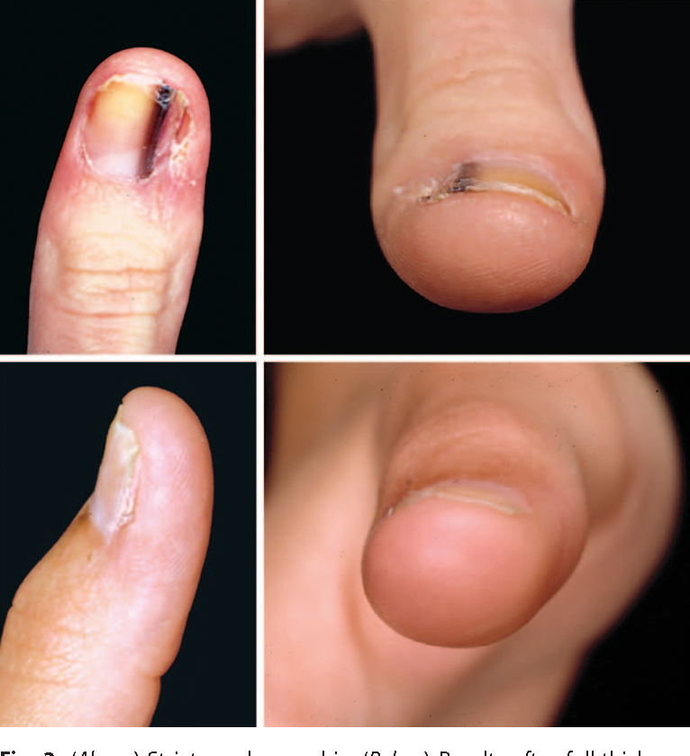 Melanoma On Thumb Nail