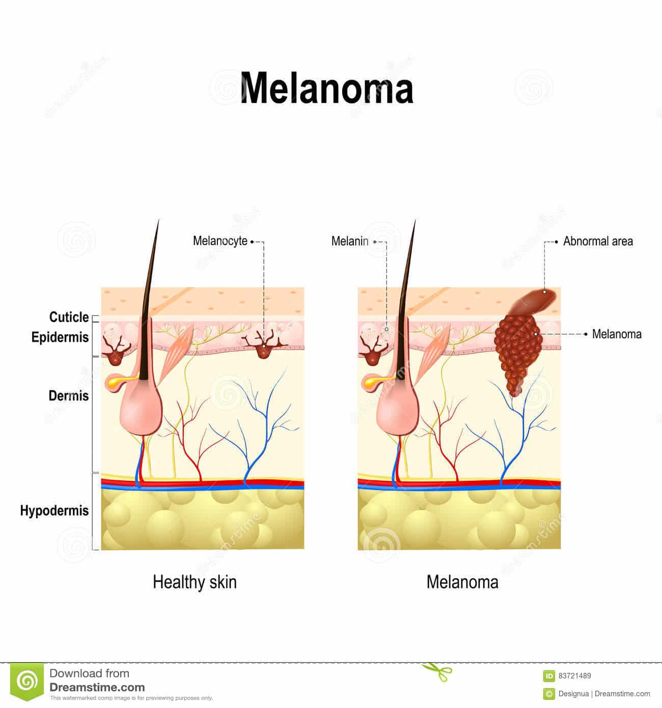 Melanoma or skin cancer. stock vector. Illustration of anatomy