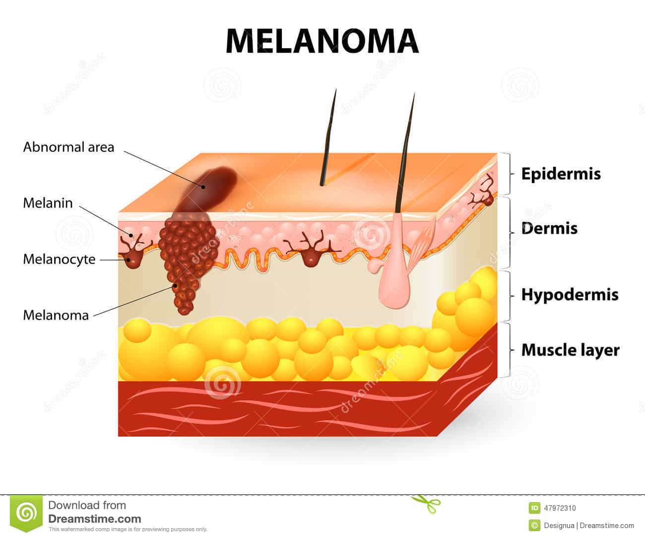Melanoma or skin cancer stock vector. Illustration of malignant