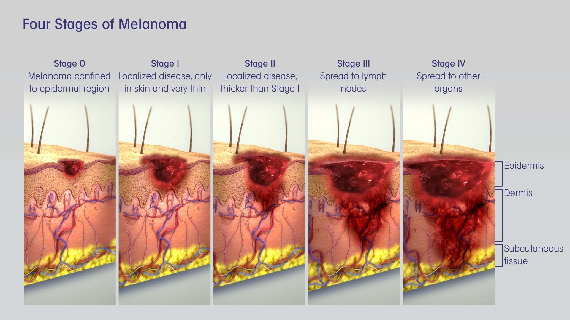 Melanoma Skin Cancer depicted &  explained using 3D medical ...