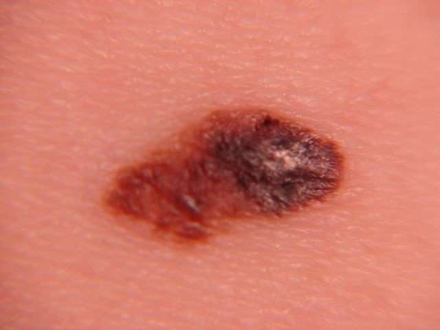 Melanoma skin cancer is deadly. Identify the signs early ...