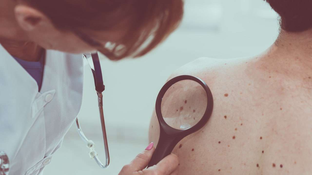 Melanoma Skin Cancer May Be Detected Early With Blood Test, Study Finds ...