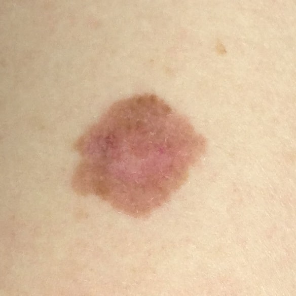 Melanoma Skin Cancer Mole