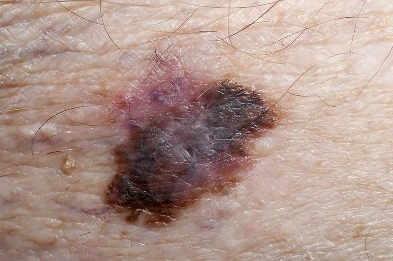 Melanoma skin cancer spread