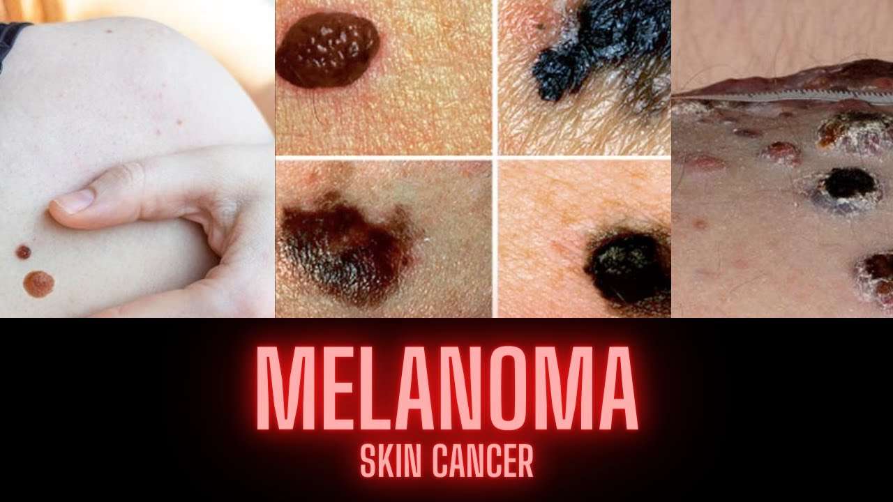 MELANOMA SKIN CANCER