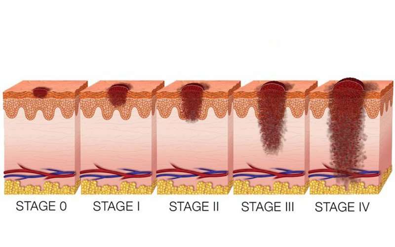 Melanoma Stages 1, 2, 3, 4, 5: Prognoses, Symptoms, Treatments