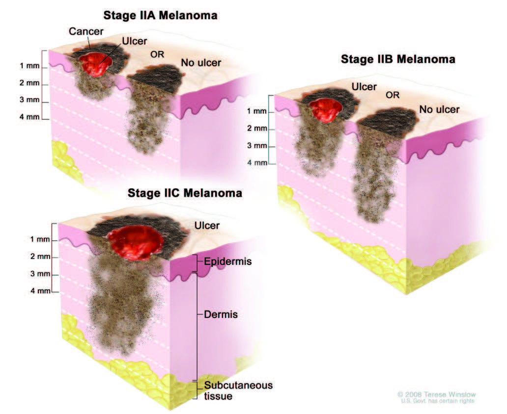 Melanoma Stages