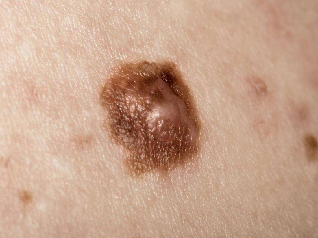 Melanoma: Stages, types, causes, and pictures