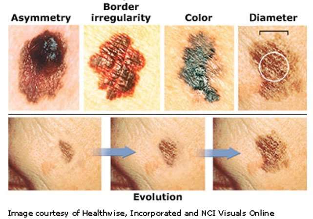 Melanoma... The Most Dangerous form of Skin Cancer ...