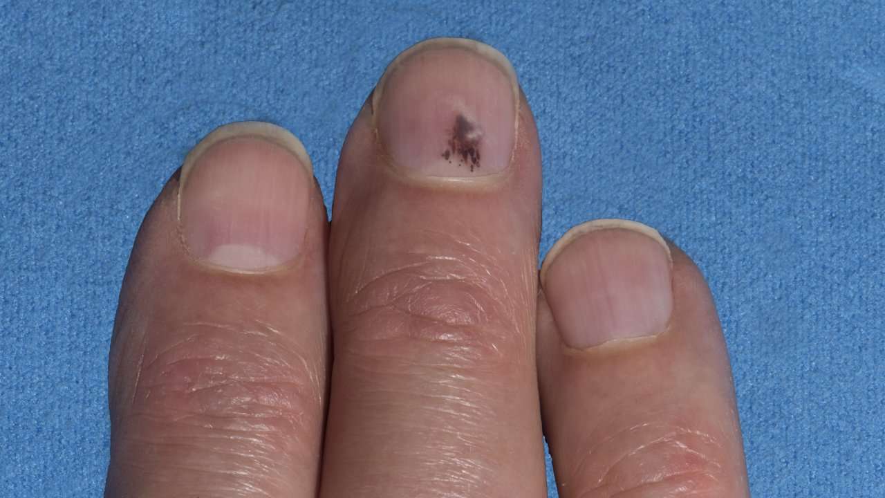 melanoma under the nail