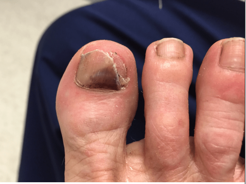 Melanoma under the toenail?