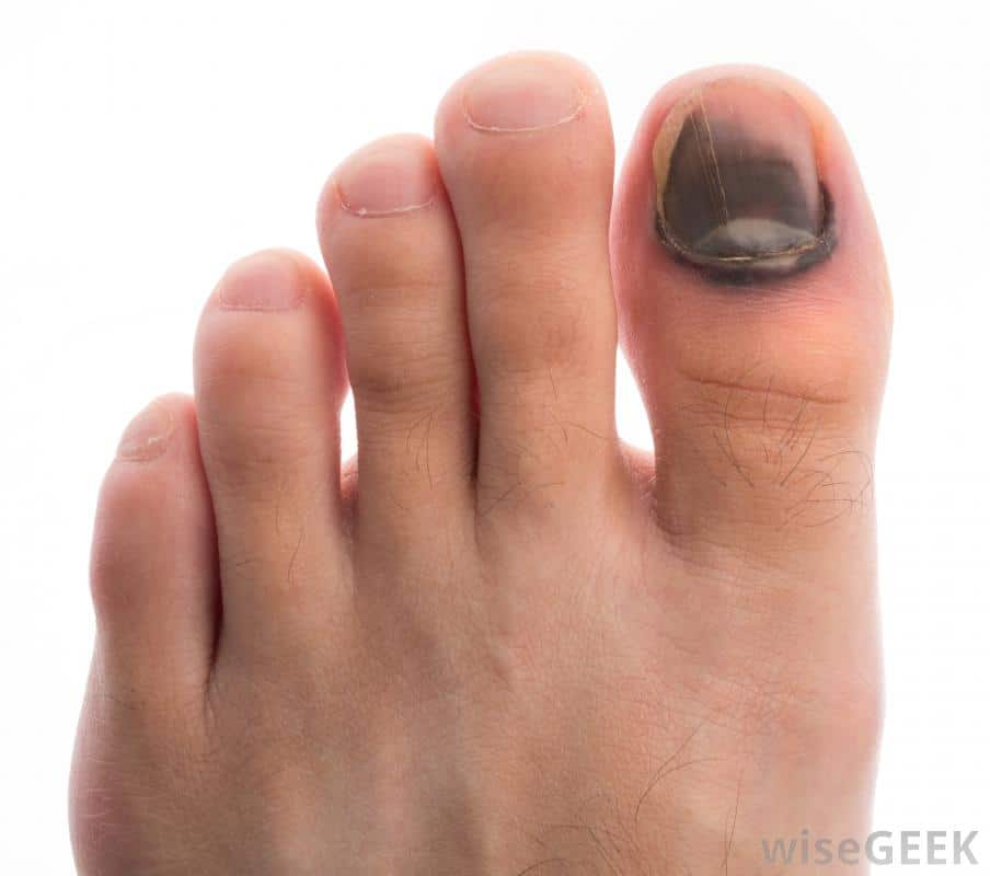 melanoma under toenails pictures