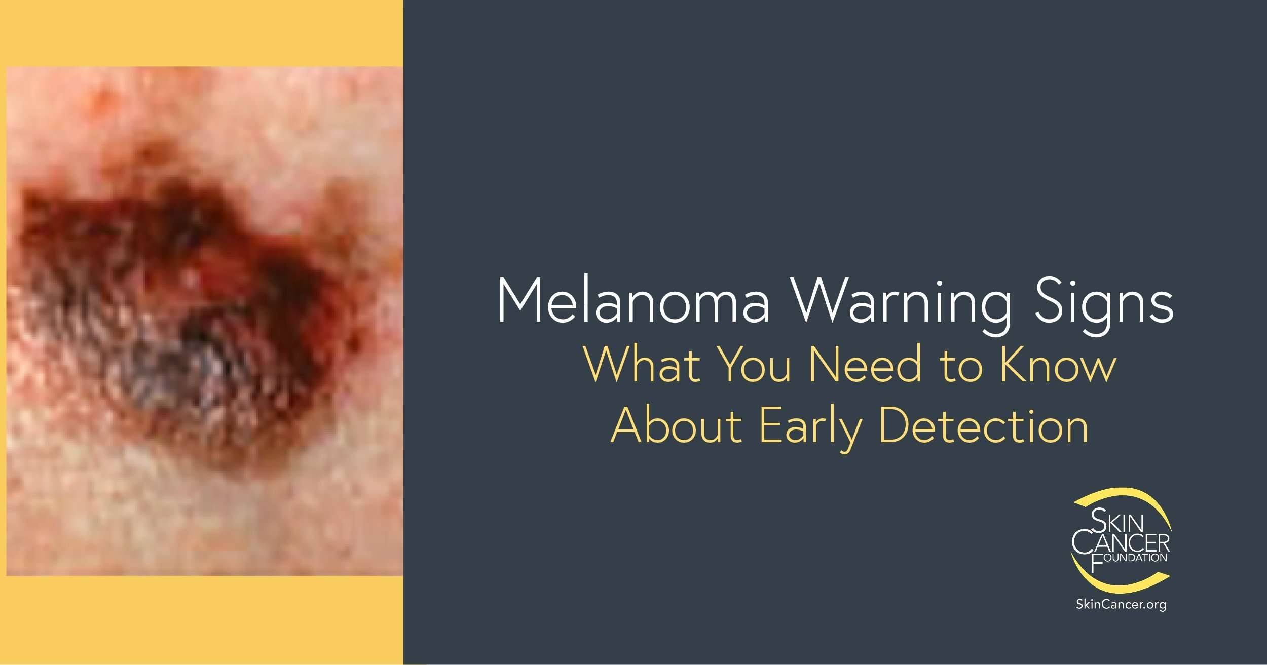 Melanoma Warning Signs and Images