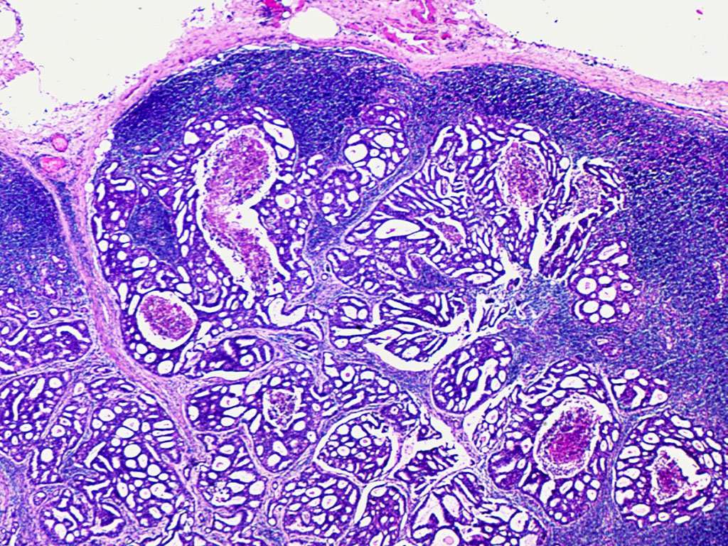 Metastatic Carcinoma Lymph Node
