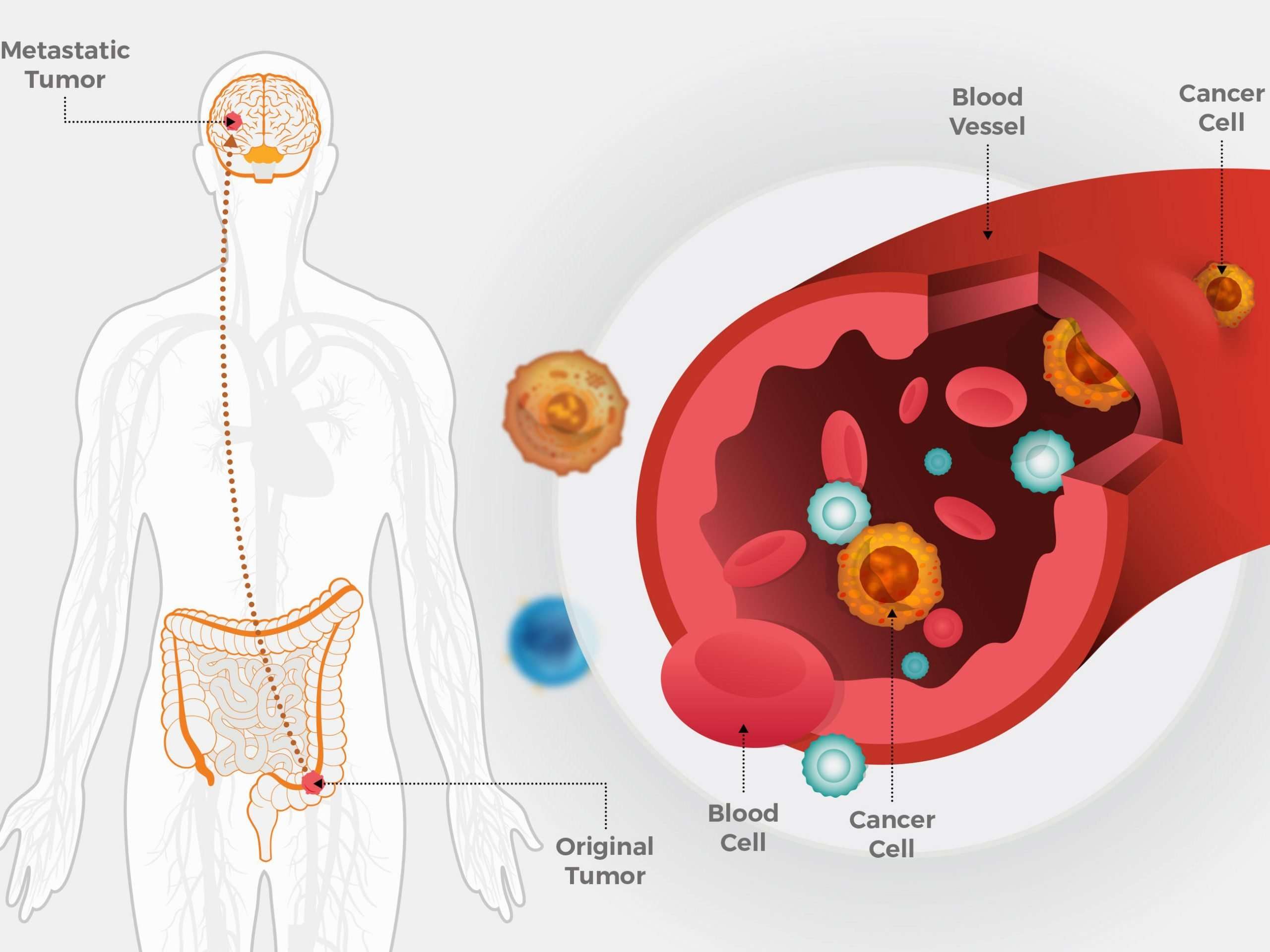 Metastatic Colorectal Cancer May Spread Early in the ...