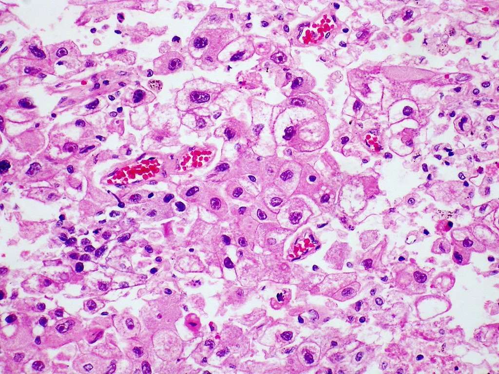 Metastatic hepatocellular carcinoma