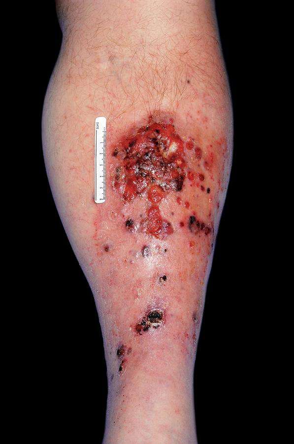 Metastatic Melanoma On A Leg Photograph by National Cancer ...
