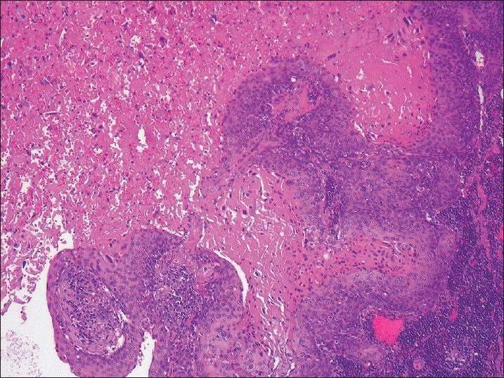 Metastatic squamous cell carcinoma to cervical lymph node ...