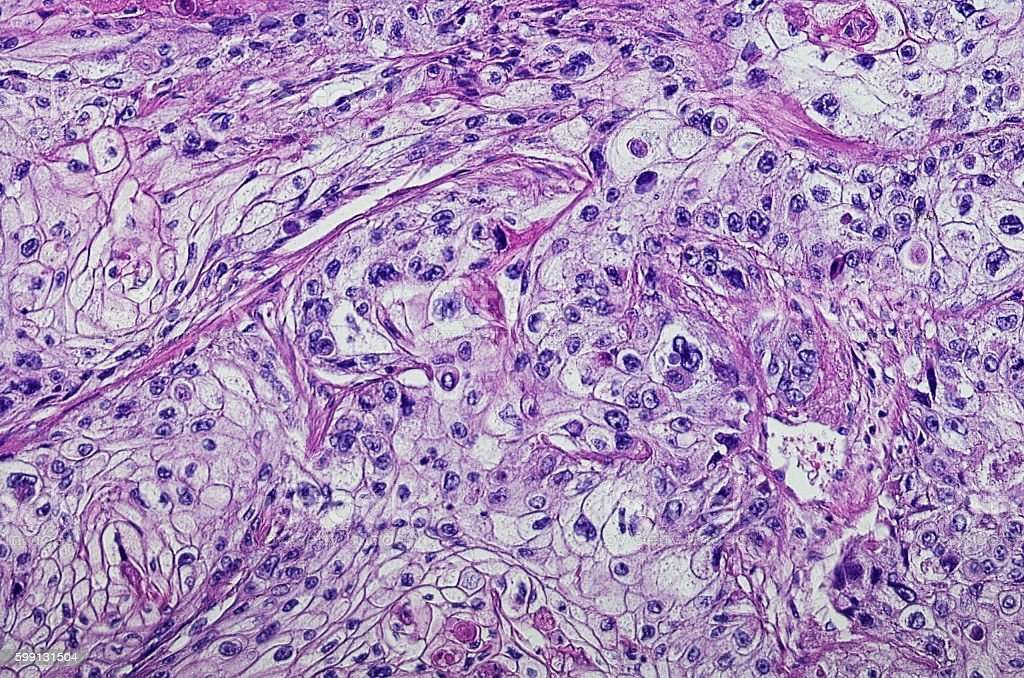 Micrograph Of Squamous Cell Carcinoma Of The Head And Neck ...