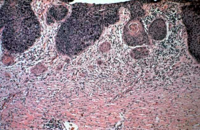 Microinvasive squamous cell cervical cancer.