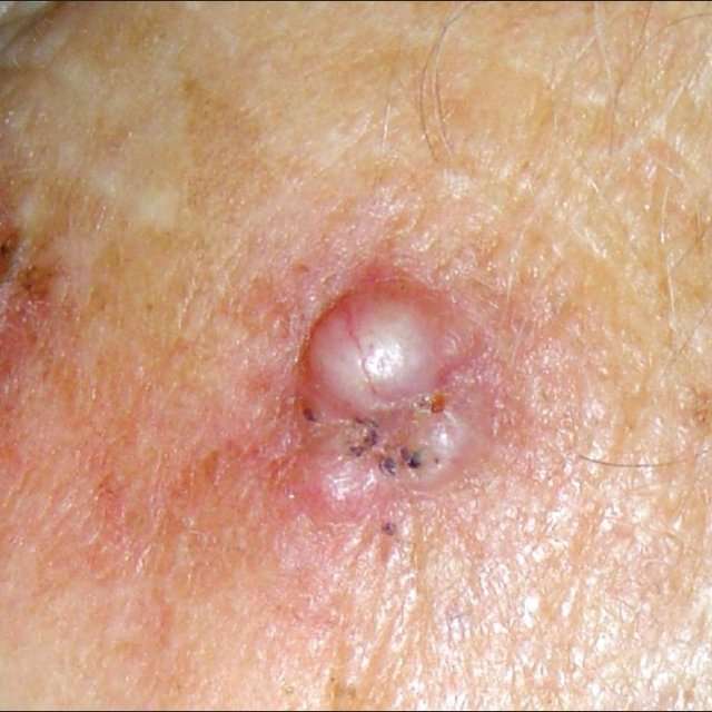 Micronodular basal cell carcinoma. Small rounded nodules ...