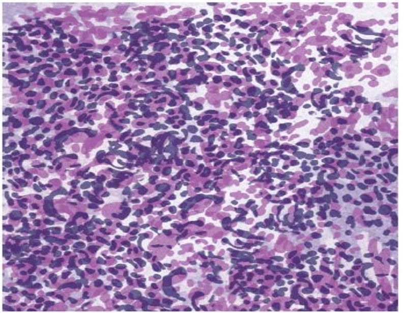 Microscopic View of Small Cell Lung Cancer