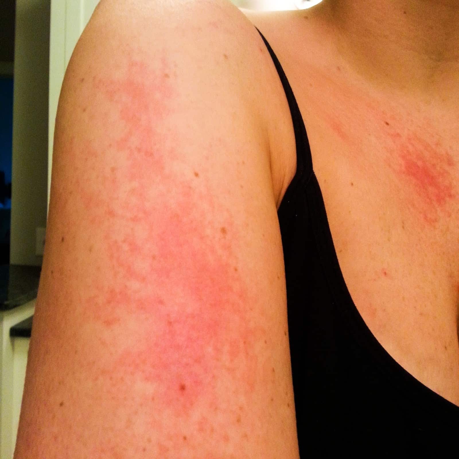 mideadesignz: Treatment For Rash On Arms