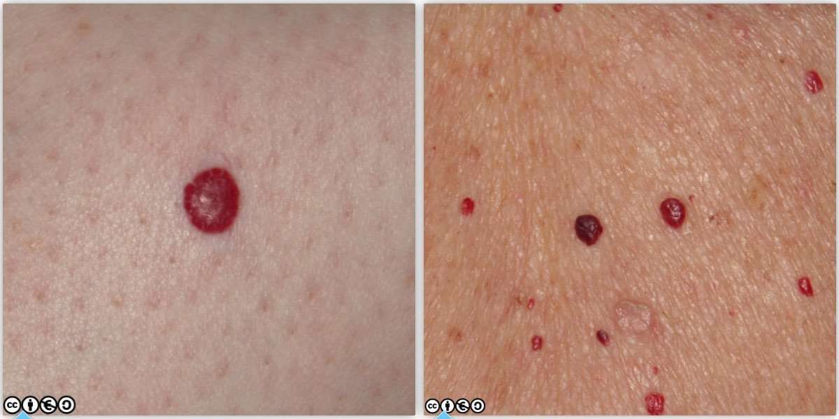 Mimics of skin cancer (ii)