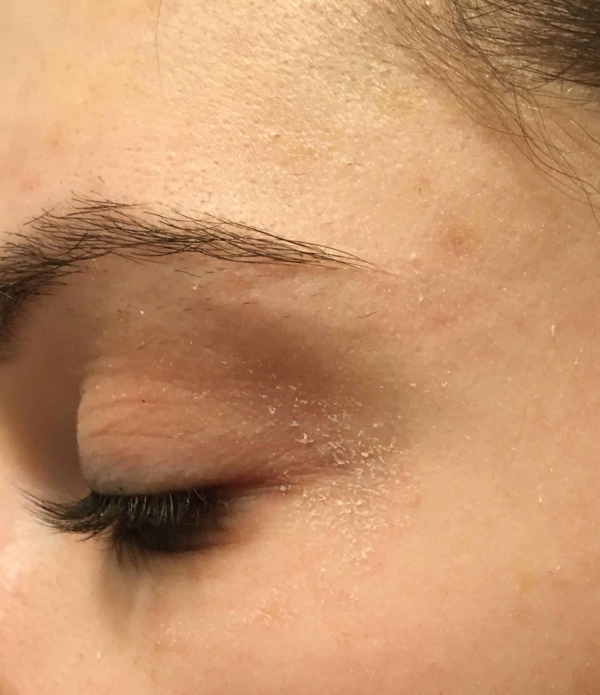 [misc] Recommendations for dry flaky skin around eyes