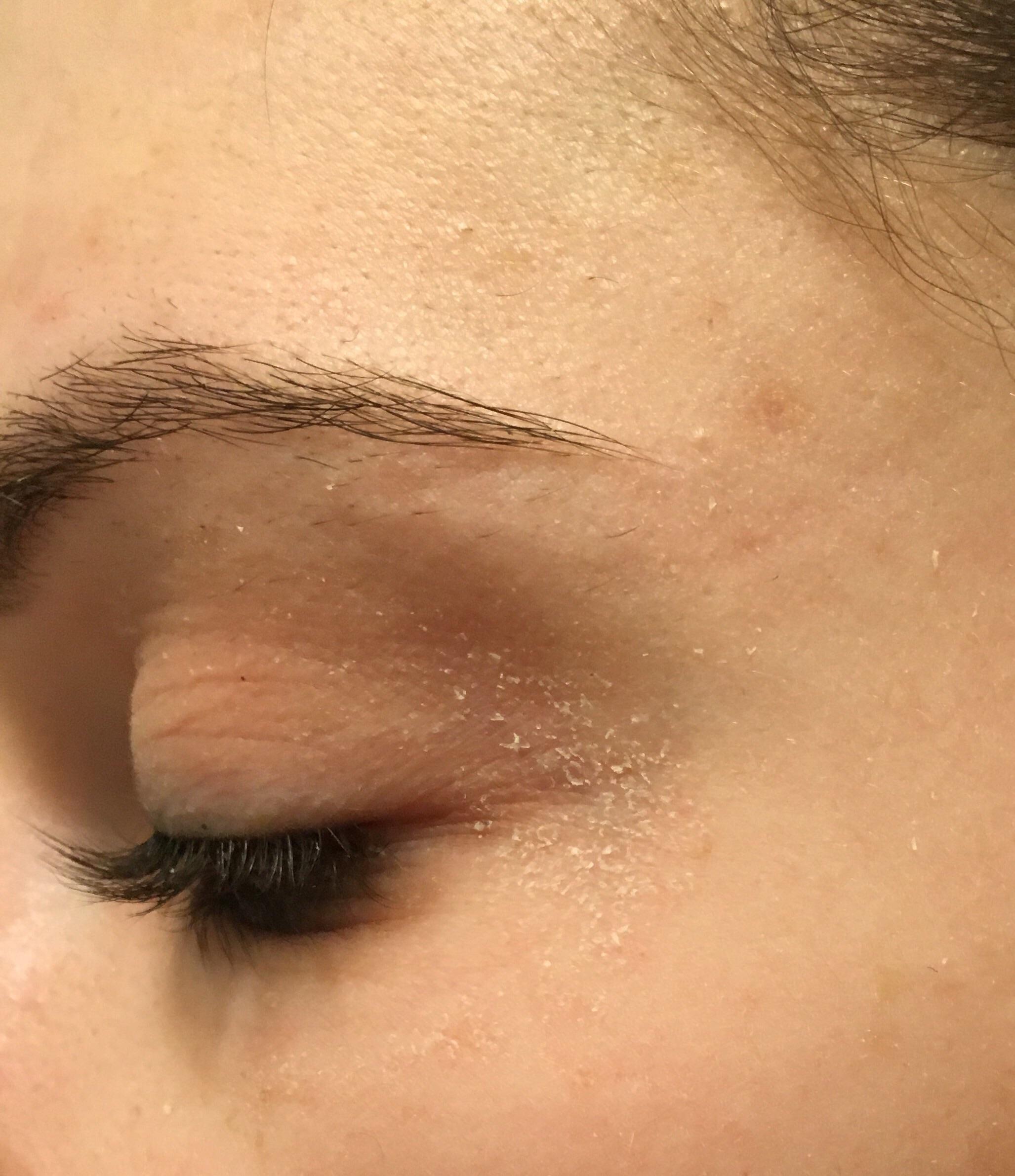 [misc] Recommendations for dry flaky skin around eyes : SkincareAddiction