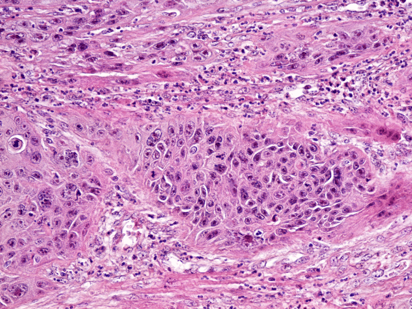 Moderately differentiated squamous cell carcinoma. HE ...