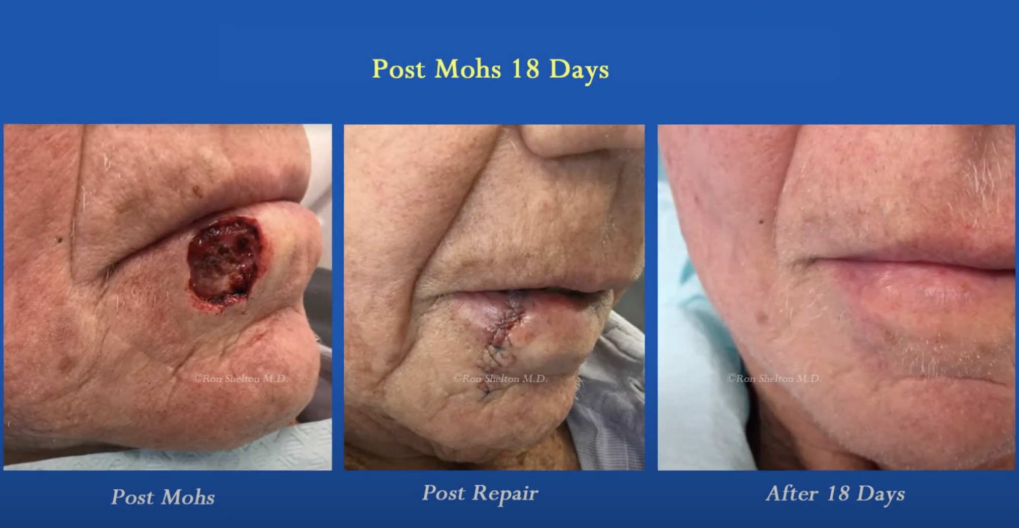 Mohs Skin Cancer Surgery New York, NY