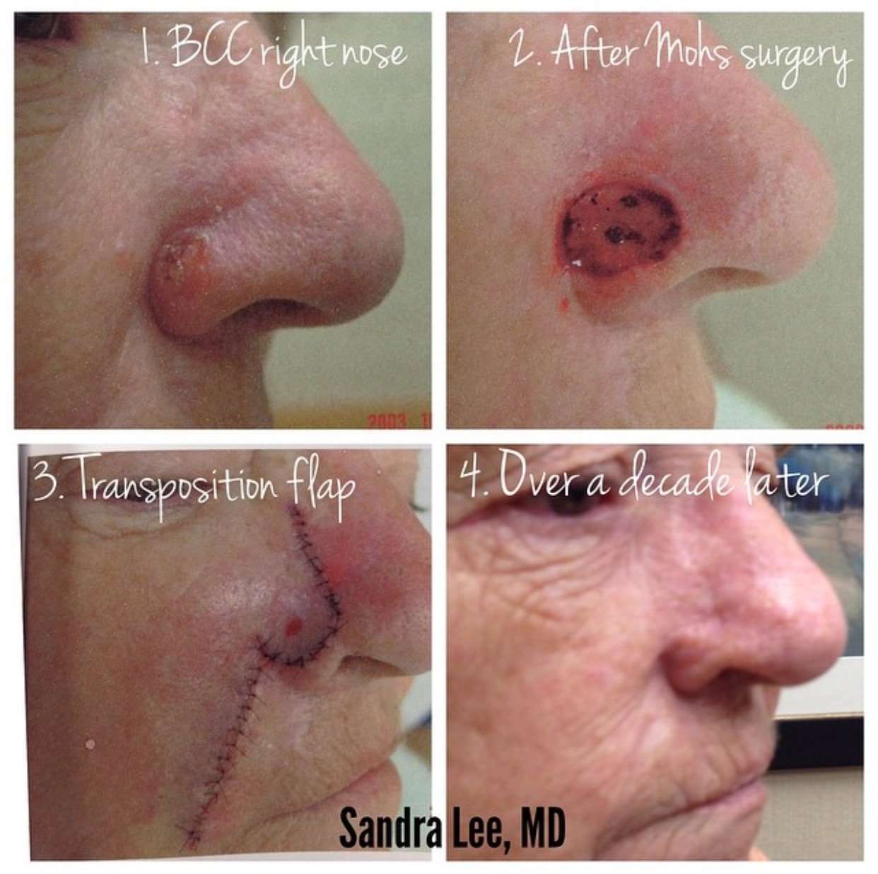 MOHs surgery skin cancer
