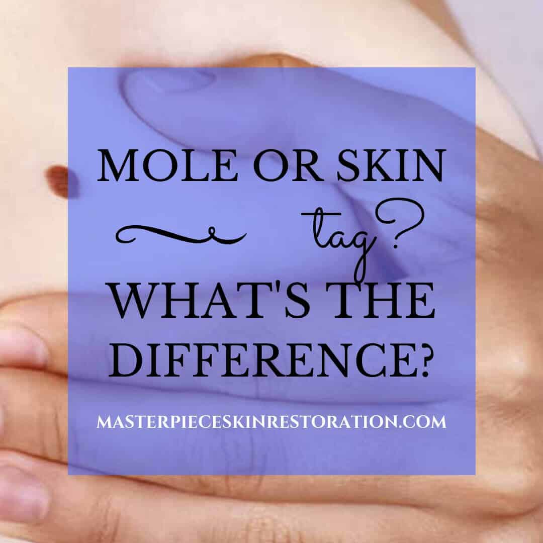 Mole or skin tag? How to Tell the Difference
